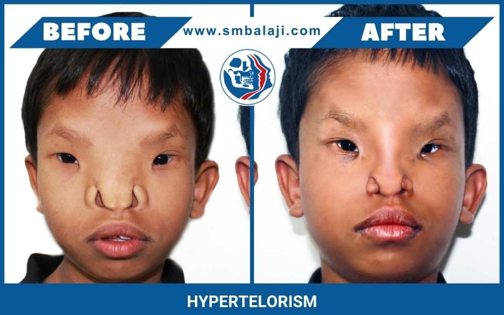 Ocular Hypertelorism Congenital Malformations Of The Eye Ento Key