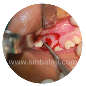 Right Tooth Surgically Exposed
