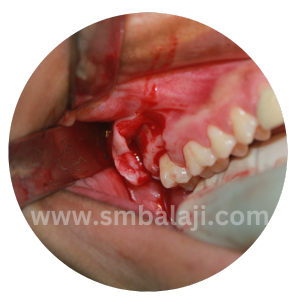 Right Tooth Surgically Exposed