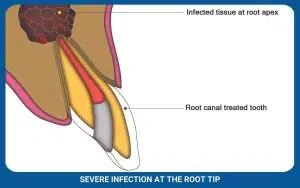 Severe Infection At The Root Tip