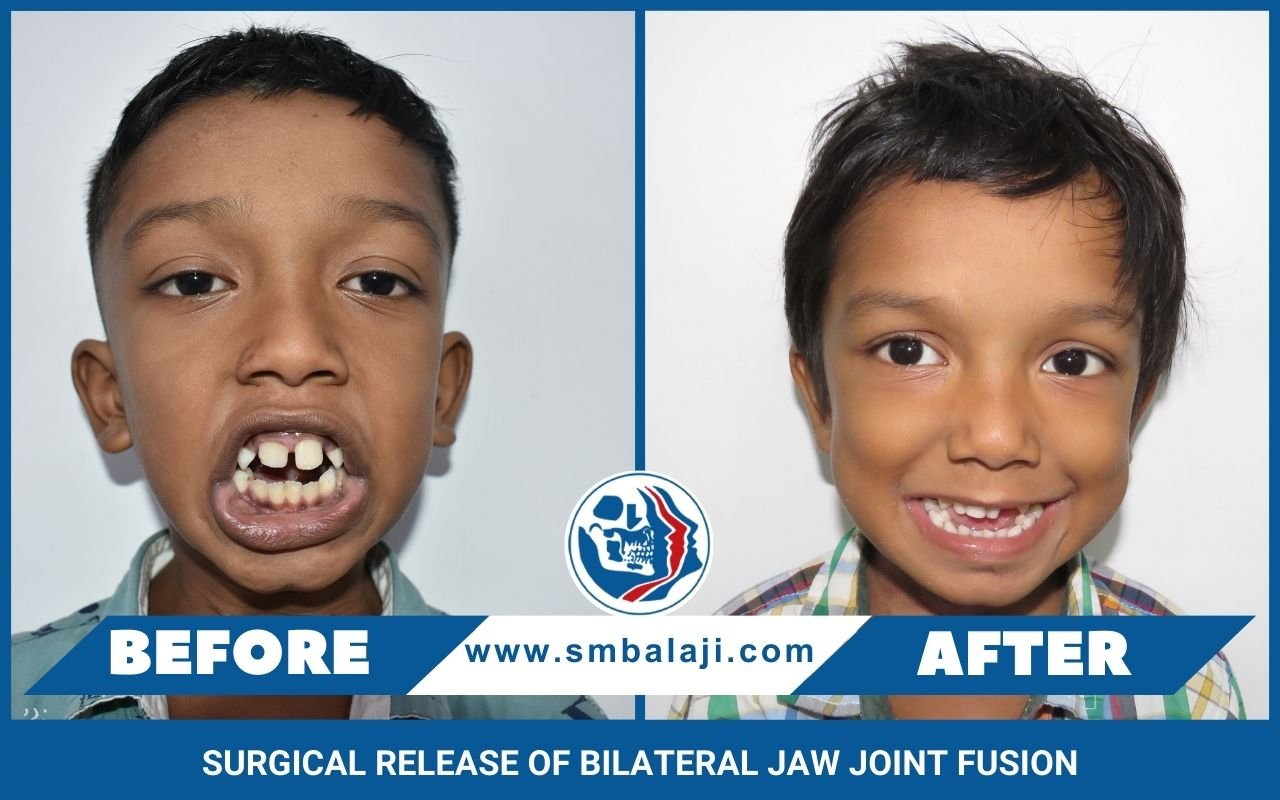 Surgical Release Of Bilateral Jaw Joint Fusion