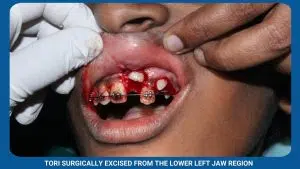 Exposure of Unerupted Teeth 4 Tori Surgically Excised From The Lower Left Jaw Region