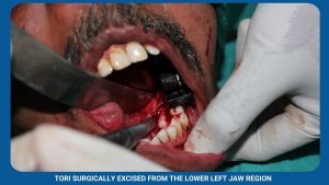 Tori Surgically Excised From The Lower Left Jaw Region