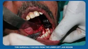 Pre-Prosthetic Surgery 4 Tori Surgically Excised From The Lower Left Jaw Region