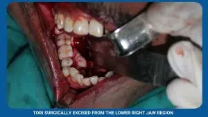 Pre-Prosthetic Surgery 5 Tori Surgically Excised From The Lower Right Jaw Region