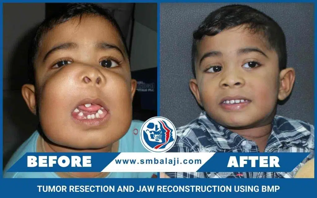 Bone Morphogenetic Protein In India