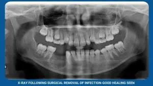 X-Ray Following Surgical Removal Of Infection-Good Healing Seen