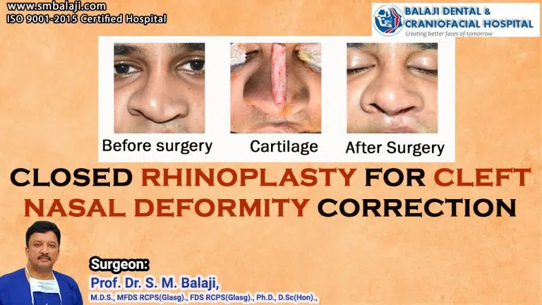 Closed Rhinoplasty For Cleft Nasal Deformity Correction