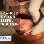 Tongue Cancer Surgery And Successful Reconstruction At Balaji Dental &Amp; Craniofacial Hospital, India.