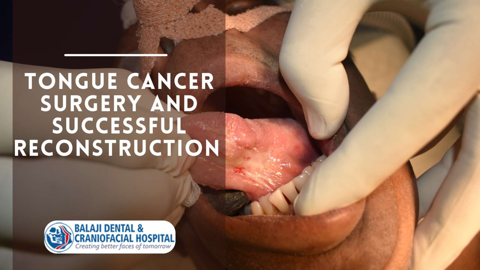 tongue-cancer-surgery-in-india-hemiglossectomy-forearm-free-flap