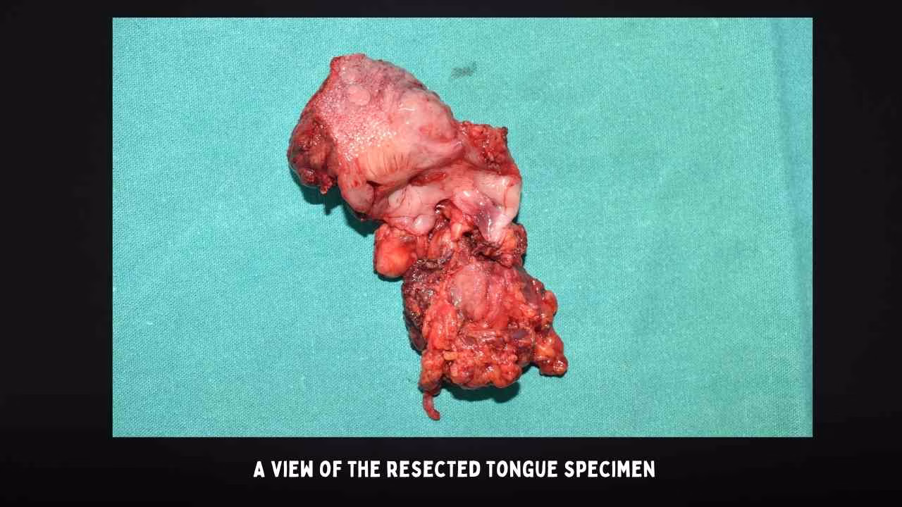 A View Of The Resected Tongue Specimen