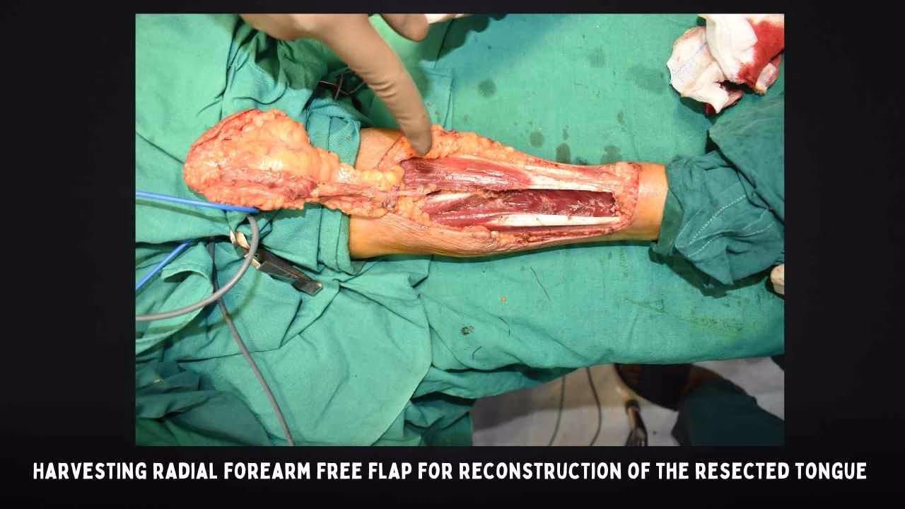 Harvesting Radial Forearm Free Flap For Reconstruction Of The Resected Tongue