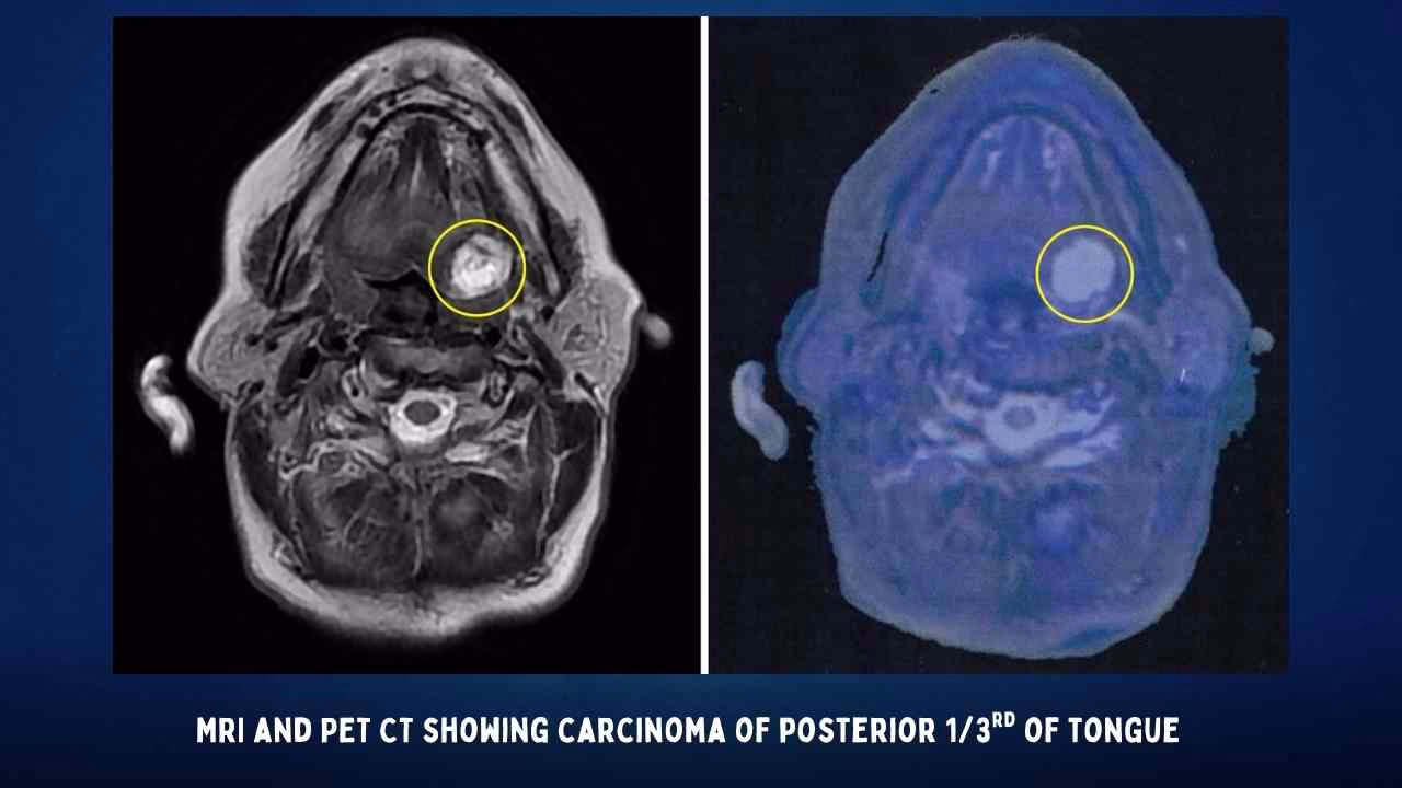 Mri And Pet Ct Showing Carcinoma Of Posterior 1_3Rd Of Tongue