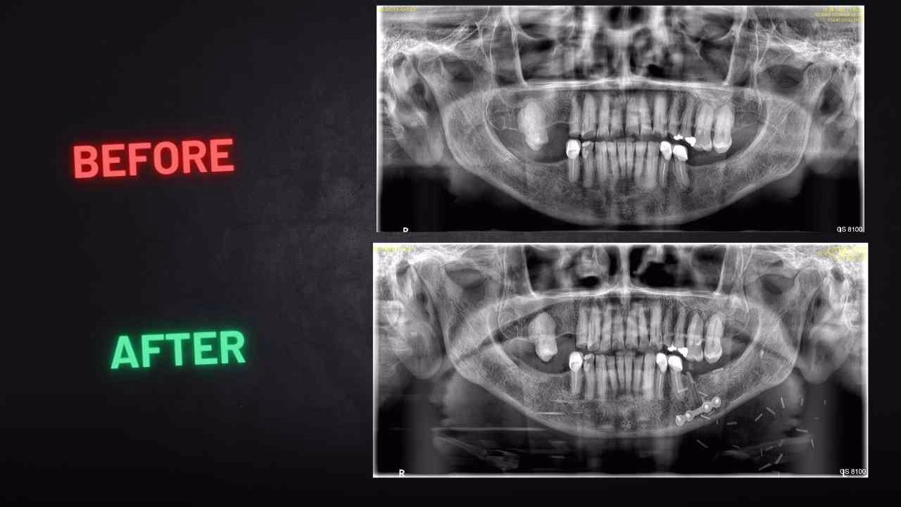 Preoperative And Postoperative Opg Of The Patient