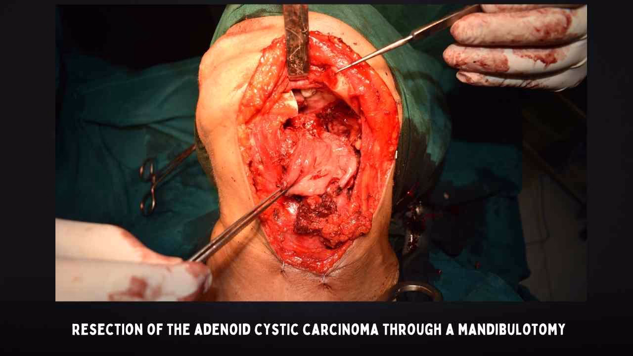 Resection Of The Adenoid Cystic Carcinoma Through A Mandibulotomy