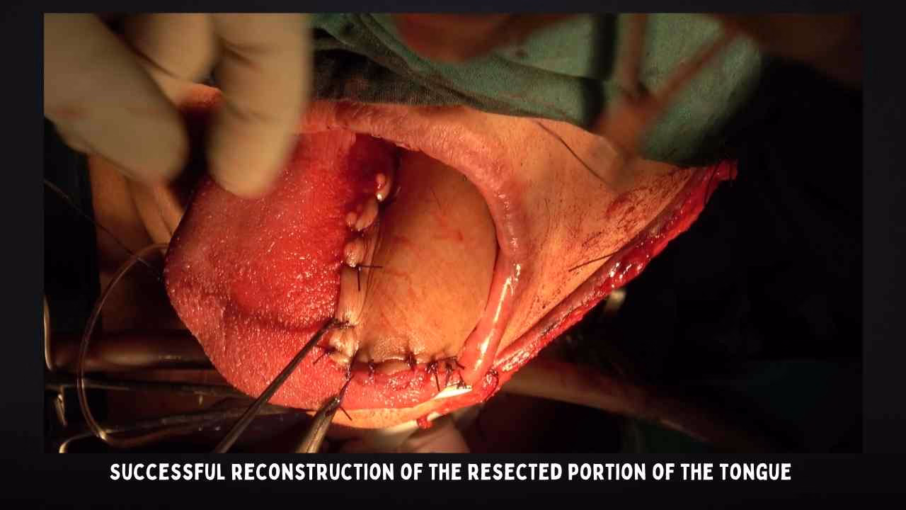 Successful Reconstruction Of The Resected Portion Of The Tongue