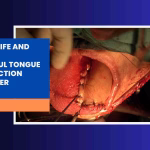 Restoring Speech &Amp; Swallowing: Successful Tongue Cancer Reconstruction In Chennai, India