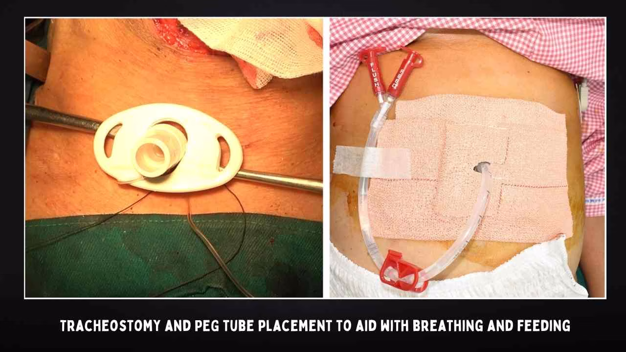 Tracheostomy And Peg Tube Placement To Aid With Breathing And Feeding