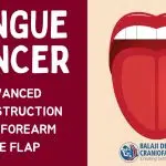 Tongue Cancer Surgery In India: Advanced Reconstruction Using Forearm Free Flap