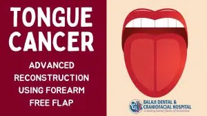 Tongue Cancer Surgery in India