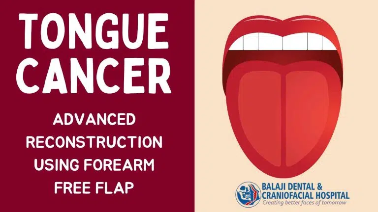 Tongue Cancer Surgery In India