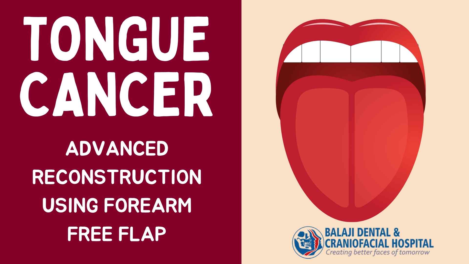 Tongue Cancer Surgery in India