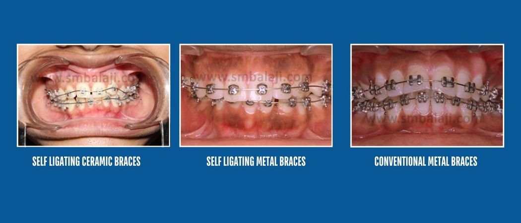 Self-Ligating Braces
