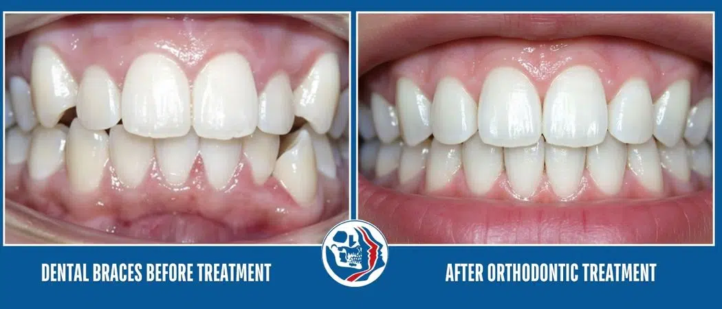 Dental Braces Treatment