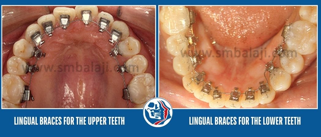 Lingual Orthodontics