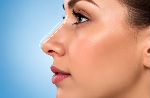 05_Rhinoplasty